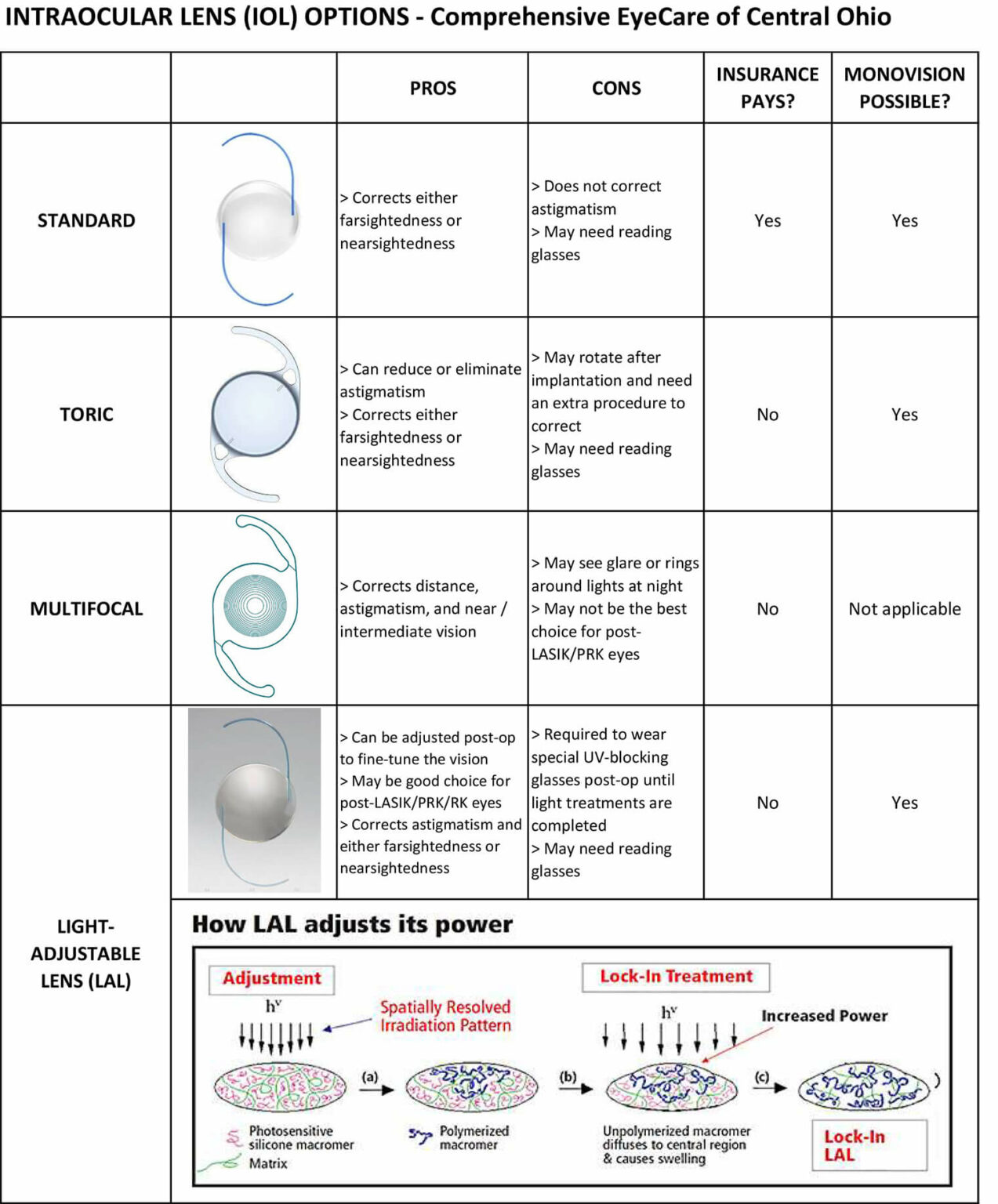 Cataract Surgery Westerville | Premium Lens Implants Columbus